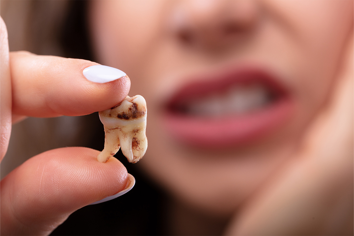 Tooth decay or dental caries